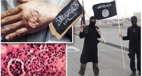 إصابة آلاف من تنظيم "داعش" بمرض ...